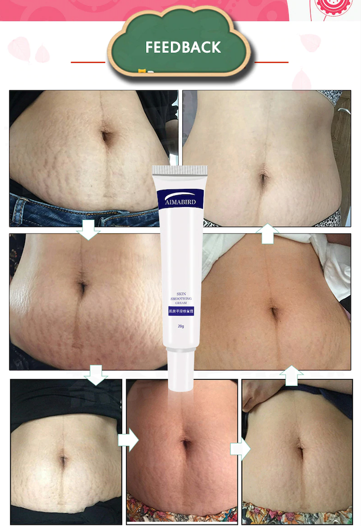 Stretch Marks Scar Removal and Skin Repair Cream